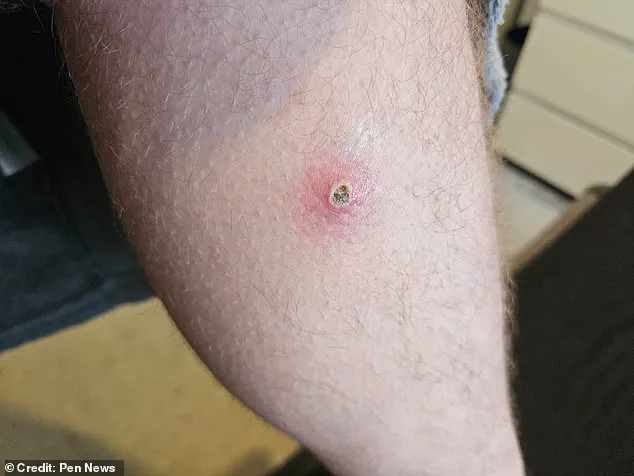 Urgent Alert: Window Cleaner Hospitalized After 'Britain's Most Dangerous Spider' Bite Sparks Renewed Safety Concerns in UK
